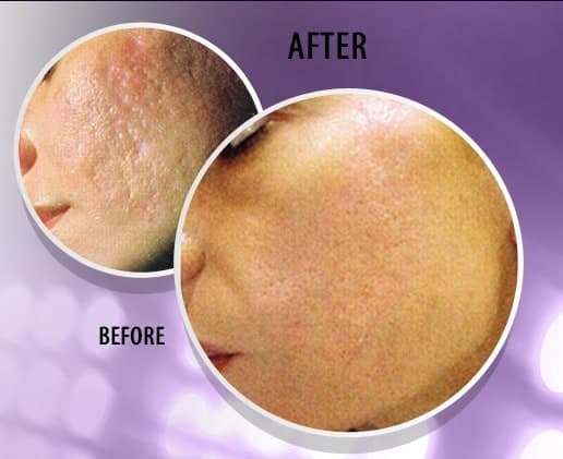 Magic Roller- dispozitiv pentru mezoterapie, acnee, riduri si linii fine