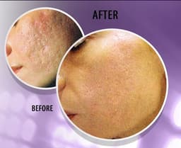 Magic Roller- dispozitiv pentru mezoterapie, acnee, riduri si linii fine