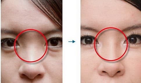 Corector Nazal Corector Nazal