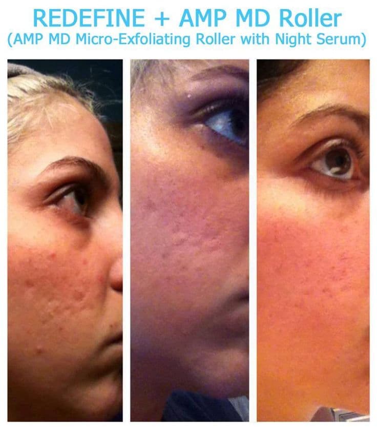 Magic Roller- dispozitiv pentru mezoterapie, acnee, riduri si linii fine Magic Roller- dispozitiv pentru mezoterapie, acnee, riduri si linii fine