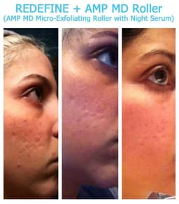 Magic Roller- dispozitiv pentru mezoterapie, acnee, riduri si linii fine Magic Roller- dispozitiv pentru mezoterapie, acnee, riduri si linii fine