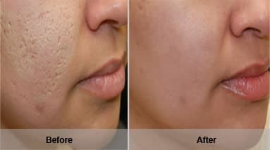 Magic Roller- dispozitiv pentru mezoterapie, acnee, riduri si linii fine Magic Roller- dispozitiv pentru mezoterapie, acnee, riduri si linii fine