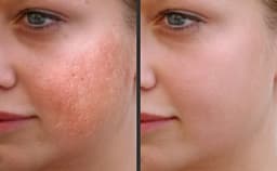 Magic Roller- dispozitiv pentru mezoterapie, acnee, riduri si linii fine Magic Roller- dispozitiv pentru mezoterapie, acnee, riduri si linii fine