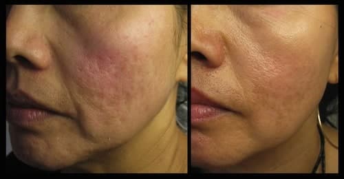 Magic Roller- dispozitiv pentru mezoterapie, acnee, riduri si linii fine Magic Roller- dispozitiv pentru mezoterapie, acnee, riduri si linii fine