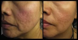 Magic Roller- dispozitiv pentru mezoterapie, acnee, riduri si linii fine Magic Roller- dispozitiv pentru mezoterapie, acnee, riduri si linii fine